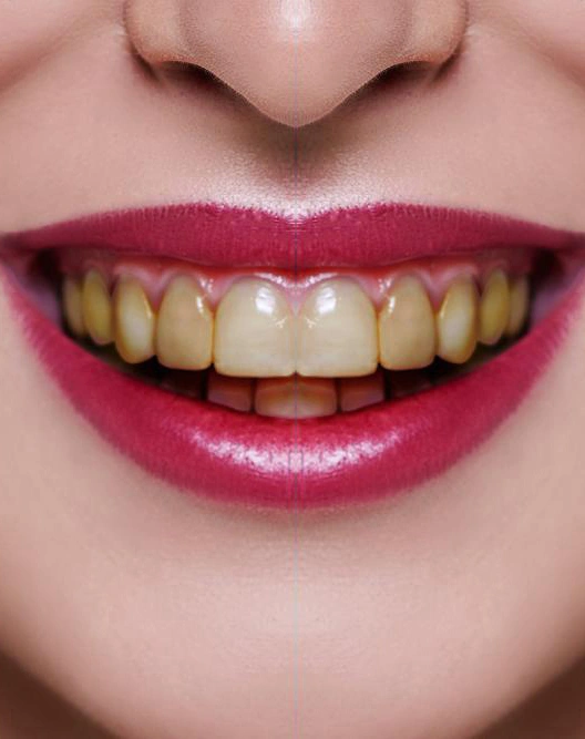 teeth02